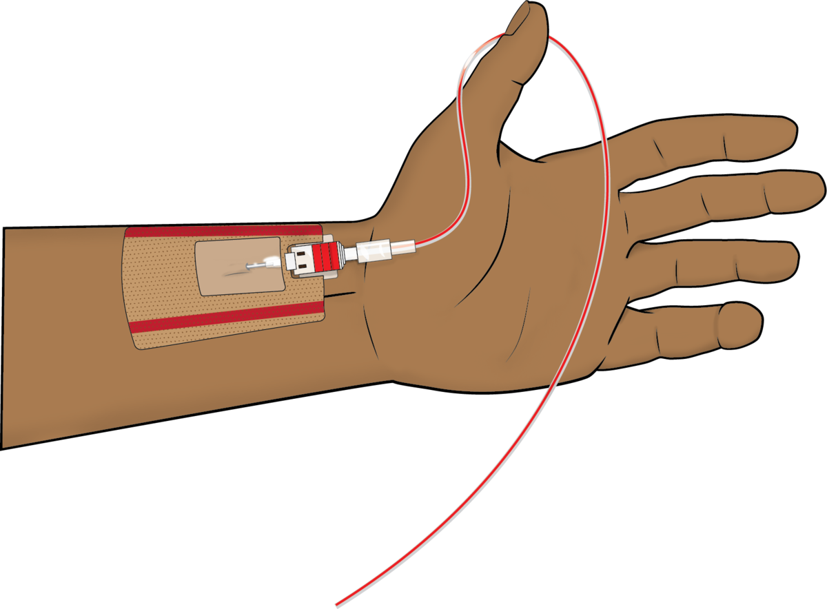 Learning to do Arterial Lines