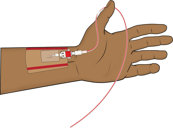 Learning to do Arterial Lines